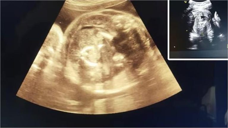 Shocking: डॉक्टर भी हुए हैरान, गर्भवती महिला के गर्भ में पल रहे बच्चे के पेट में मिला एक और भ्रूण